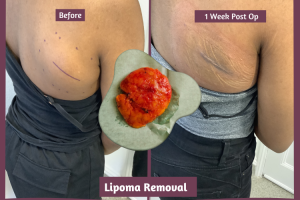 Lipoma on flank