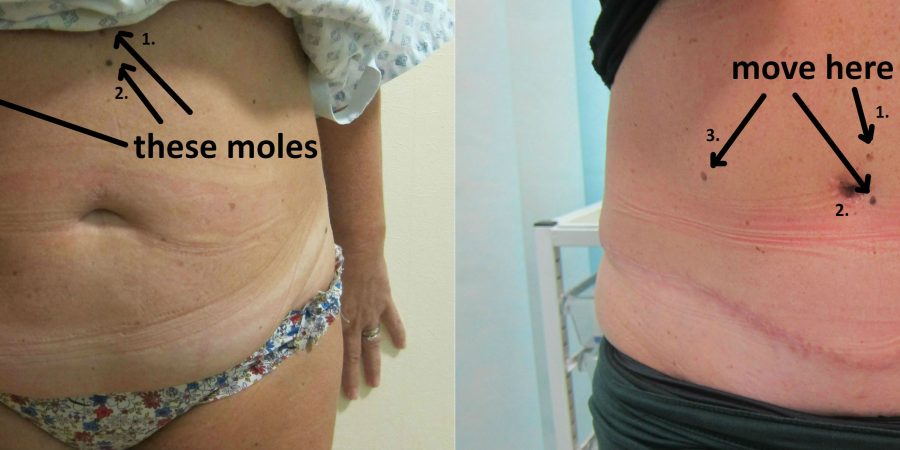 All About Belly Button After Tummy Tuck