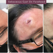 Sebaceous cyst on forehead at 1 week after