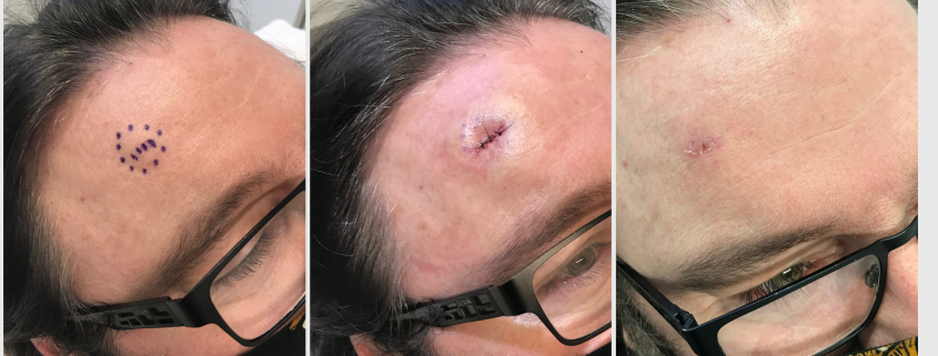 Sebaceous cyst on forehead at 1 week after