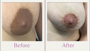 areola reduction