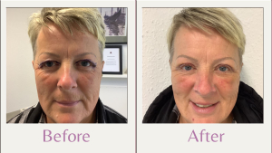 upper blepharoplasty at 1 week