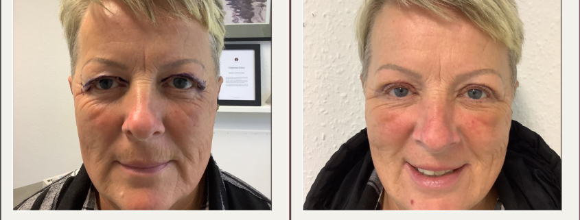 upper blepharoplasty at 1 week